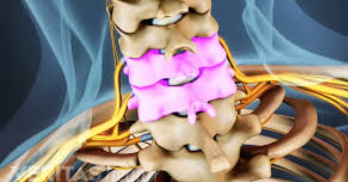 Foraminotomy Surgery