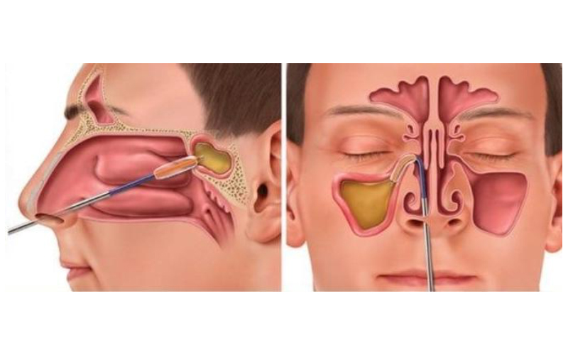 chronic sinusitis surgery